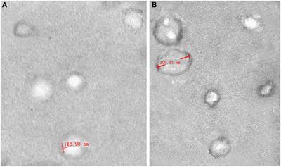 Comparative Gene Expression Analysis of Lymphocytes Treated with Exosomes Derived from Ovarian Cancer and <mark class="highlighted">Ovarian Cysts</mark>